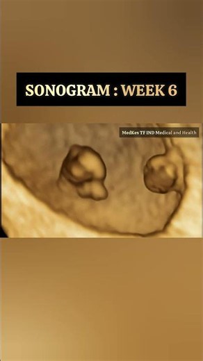 Sonogram : Week 6