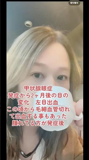【バセドウ病】アイソトープ後甲状腺眼症になった目の経過 #50代 #バセドウ病 #甲状腺眼症#アイソトープ#治療