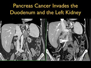 20 reactions | Pancreas Cancer Invades the Duodenum and the Left Kidney View the images here: https://www.ctisus.com/teachingfiles/cases/pancreas/414446 | CTisus: Cutting edge information on body CT (Computed tomography). | Facebook