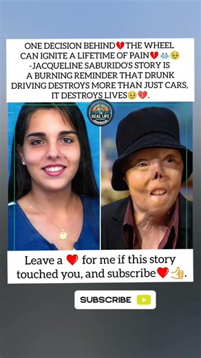 She Survived the 💔🥹fire🔥… But Lost Her Face to a Drunk Driver 💔🥹.#emotionalstory #hearttouching.