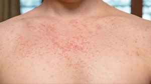 Warning for Ryanair passengers on Irish flight after case of measles confirmed