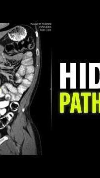 RLQ Pain & a Large Appendiceal Mass | Gastrointestinal Case 58