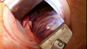 Closeup cardiovascular open heart surgery instruments in surgeon operation electrosurgery doctor in surgery center for interventions with thoracotomy microsurgery minimal invasive