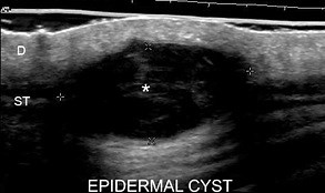 Sonography and Diagnosing Skin Integrity Issues