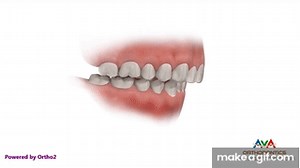 Orthodontics Treatment for Overjet (Overbite) - Herbst Appliance on Make a GIF