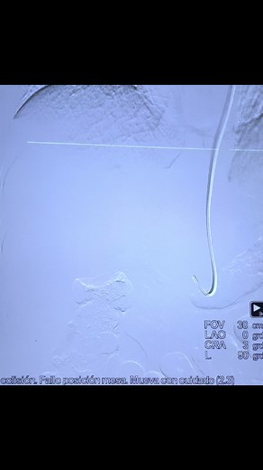 ¿Que es embolization? Son todos aquellos procedimientos en los que por alguna estrategia quirúrgica se busca ocluir o diminuir el flujo de sangre a una estructura anatómica —— este es un caso de el manejo endovascular que un tumor hepatico benigno con el fin de controlar dolor y buscar disminución del tamaño de la lesion #endovascular #embolization #vascular #surgery #neiva