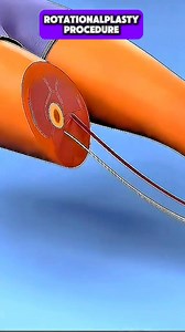 3.9K views | Rotationalplasty is a life-altering surgery often done...
