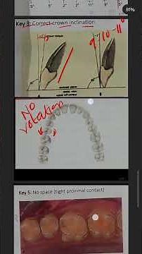 Andrew's 6 keys of Normal Occlusion | Orthodontics | #dental #orthodontics #occlusion #dentist #prof