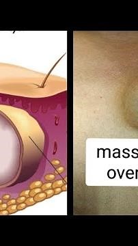 large massive seabaceous cyst over chest | cyst | excision of cyst #youtube #doctor #dr