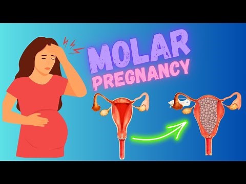 Molar pregnancy | Hydatiform Mole, Risk Factors, Types, Symptoms, Diagnosis, And Treatment (GTD)
