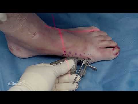 Arthrex Minimally Invasive Bunionectomy With MIS Parallel Guides