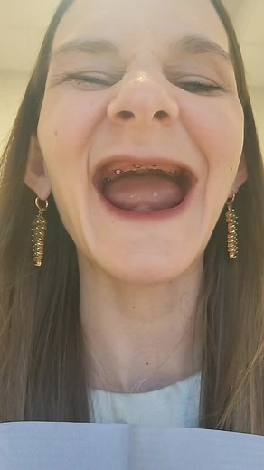 Transforming Toothless Smiles with Dental Implants