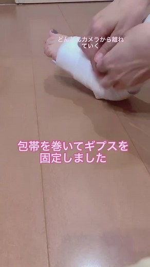 腕のギプス固定と骨折治療のコツ