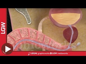 Urethral Catheterization surgery 3D animation