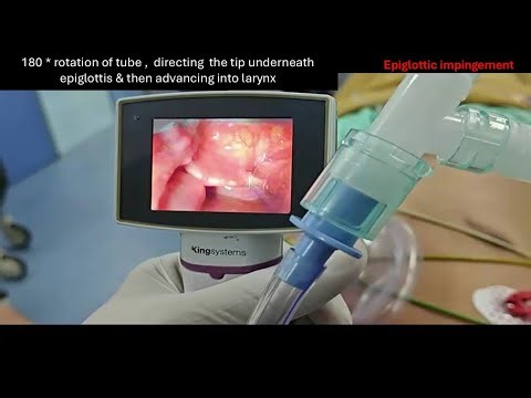 Videolaryngoscopy Session IIIa Channel blade troubleshooting by Dr Apeksh Patwa