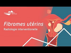 Les fibromes utérins et leur traitement par embolisation