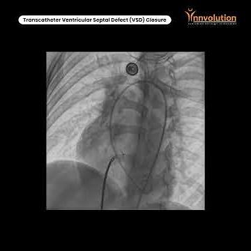 Transcatheter Ventricular Septal Defect VSD