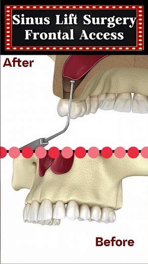 What is sinus lift surgery with frontal access?