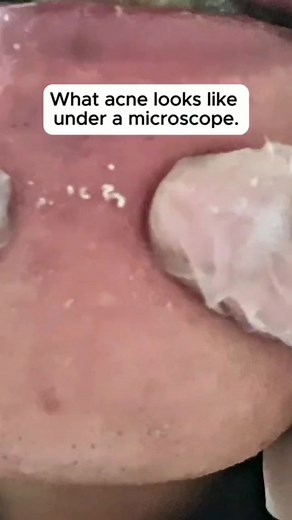 1K views | Acne under the microscope | føłľòŵ fóř fùłl video #microscope #reels #education | Nurse Divine Mercy | Facebook