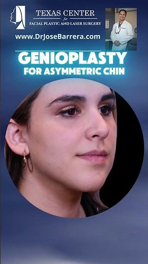 Before and after of a Genioplasty procedure to correct an asymmetric chin
