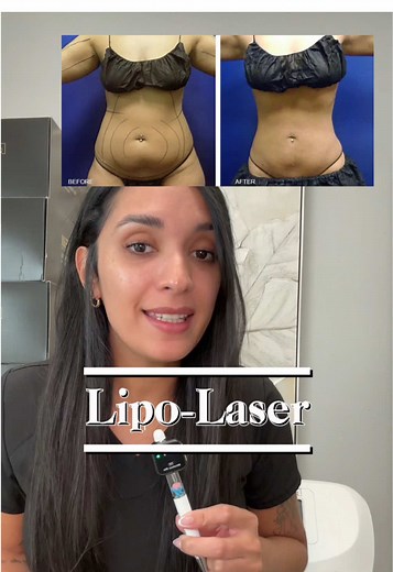 Lipo-laser sin quirófano, sin daños en la piel y con más beneficios. Liposuccion con láser ahora disponible en tu med spa @sebellaaesthetics #lipolaser #liposuction #liposuccion #lipolaserresults #beforeandafter #bodytransformation