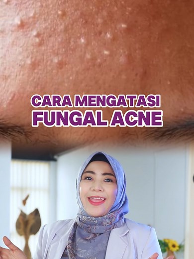 Hai Sobat Cantik 👋🏻 Lanjutan dari video edukasi sebelumnya ya, gimana sih cara mengatasi Fungal Acne ? untuk memastikan apakah itu benar Fungal acne atau bukan disarankan untuk kalian konsultasi langsung ke dokter kulit. Yuk.. bareng kita tonton video kali ini sampai selesai ya Semoga Bermanfaat 𝑲𝒐𝒏𝒔𝒖𝒍𝒕𝒂𝒔𝒊 𝒐𝒏𝒍𝒊𝒏𝒆 𝒅𝒂𝒏 𝒓𝒆𝒔𝒆𝒓𝒗𝒂𝒔𝒊 𝒄𝒆𝒌 𝒍𝒊𝒏𝒌 𝒃𝒊𝒐 ⬆️⬆️⬆️ #tanyadokter #fungalacne #alzenaskincare #fyp #salamcantik