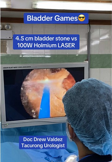 Effective Bladder Stone Removal Using LASER Technology