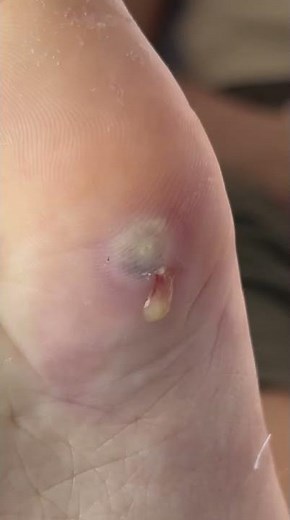 Pus Explosion from Deep Foot Infection – So Satisfying to Watch!