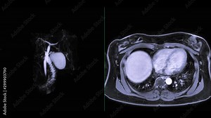 Magnetic resonance cholangiopancreatography or MRCP 3D MIP image compare Axial T1W Post GD to visualize the biliary and pancreatic ducts .