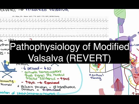 REVERT Procedure for SVT: The Science Behind the Modified Valsalva Maneuver