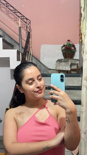 1 month 15 days in🩹 I’m finally seeing gentleness where there was pain🤍 #postpacemakersurgery #stitchesprogress #recoverydiaries #month1progress #strongerthanyesterday #pacemakergirl | Petite Fits