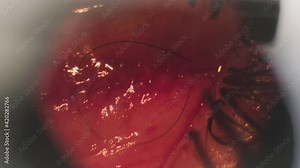 Surgery to correct strabismus. View through a microscope. The surgeon sews up the eye. Оphthalmic surgery