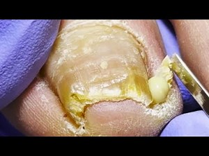 Wow ~ Crazy Ingrown Nails, Leaking A Lot Of Pus【Dr Liu's Pedicur】