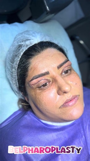 **Upper Blepharoplasty Before & After 👁️ | See the Transformation!**