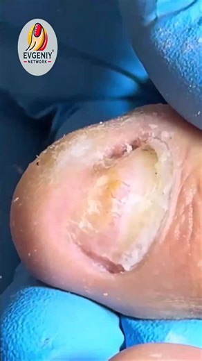 Brittle Toenails: effective care for lasting results 🪷 #FootSupport #EverydayCare #SeniorHealth | Evgeniy