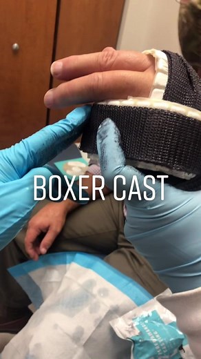 Waterproof boxer cast on a patient :-) #foryoupage #fypシ #foryou
