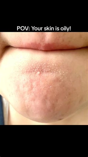 18K views · 122 reactions | Sebaceous filaments are a natural, normal process of your skin. If you have very oily skin, when pores fill up with oil, they become sebaceous filaments, the little yellow and gray dots you notice along your nose and chin. Wash your face with Salicylic ac | Dr. Farzan | Facebook