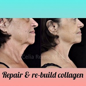 13 reactions | Venus Freeze, results that last! Vitality is offering 30% off your first Venus Freeze package with a FREE microdermabrasion to help prep the skin for that glowing result you’re looking for this holiday season! Buy two packages and save 40%! Call 916.508.8640 Folsom or 916.797.1131 Roseville to find out more! | Vitality Stem Cell & Aesthetic Medicine | Facebook