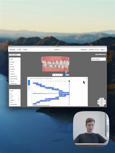 ArchForm on Instagram: "You can now use the Advanced Staging feature to do sequential distalization with partial anchorage"