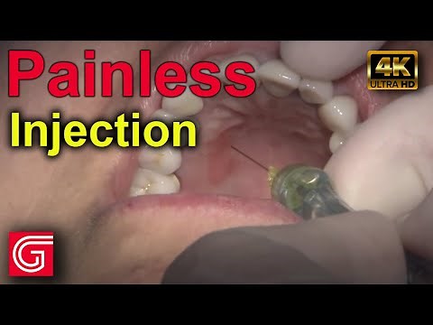 How to Give Painless Dental Injection by Michael DiTolla, DDS, FAGD