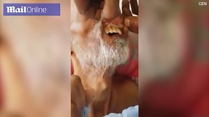 South African hospital patient has maggots wriggling in his mouth