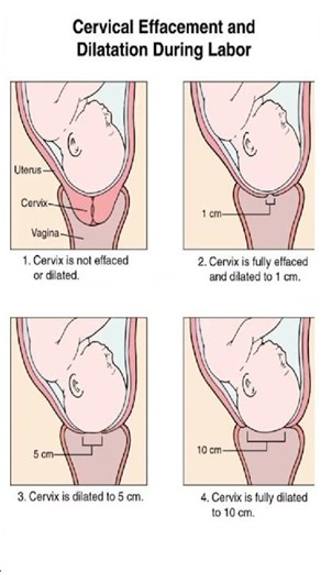 Cervical Effacement and Dilation During Labor Explained | Midwifery Nursing Education