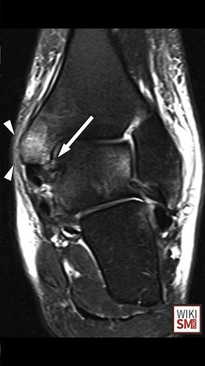 🦴 Medial Ankle Sprain Explained! #anklepain #meded #physiotherapist #ATC #orthopedic #podiatry
