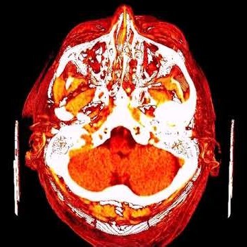 CT Brain - Brain Non Con – Axial