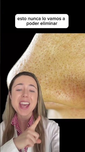 Blackheads or sebaceous filaments: Dermatologist explains ❤️ #blackheads #comedones #dermatologist