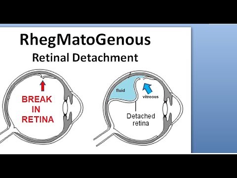 Ophthalmology 308 Rhegmatogenous Retinal Detachment Primary Complication Treatment Marcus Gunn Pupil