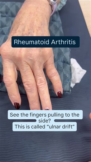 1.8K views · 3 comments | Rheumatoid Arthritis (RA) over time, can...
