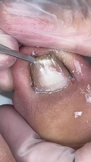 Effective Ways to Clean Dirty Toenails