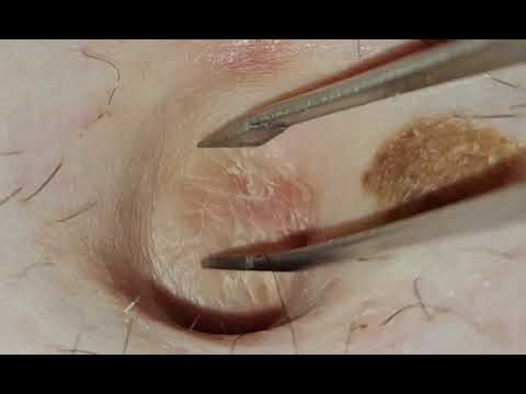 Close up tweezer action in bellybutton