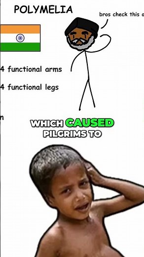 Born With Extra Limbs: The Amazing Deepak Paswan Story #shorts